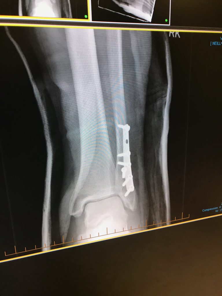 Screws and plate on broken fibula